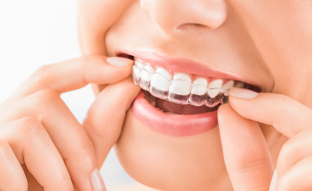 Aparat ortodontyczny bez drutow – czy to mozliwe Nowoczesny metody w leczeniu ortodontycznym